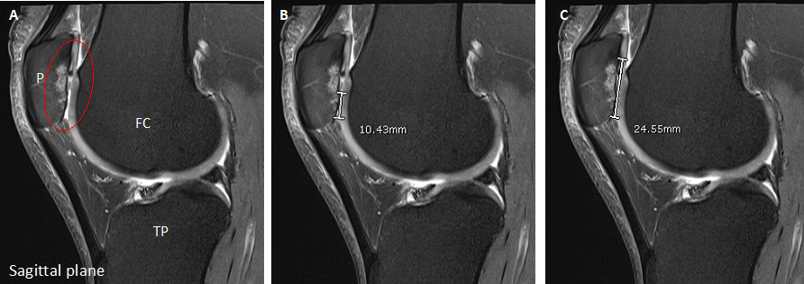 patella (2)